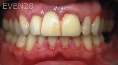 Robert-McHarris-Dental-Crown-before-1