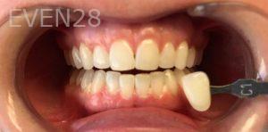 Robert-McHarris-Teeth-Whitening-after-1