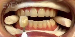 Robert-McHarris-Teeth-Whitening-before-1