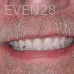 Robert-Wolf-Dental-Implants-Full-Mouth-after-1