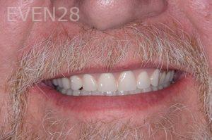 Robert-Wolf-Dental-Implants-Full-Mouth-after-1