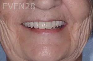 Robert-Wolf-Dental-Implants-Full-Mouth-after-8