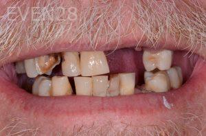 Robert-Wolf-Dental-Implants-Full-Mouth-before-1