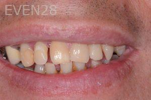 Robert-Wolf-Dental-Implants-Full-Mouth-before-2