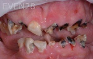 Robert-Wolf-Dental-Implants-Full-Mouth-before-3