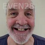 Robert-Wolf-Dental-Implants-Full-Mouth-before-7