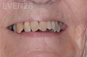 Robert-Wolf-Dental-Implants-Full-Mouth-before-8