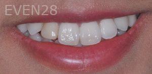 Sarah-Jebreil-Teeth-Whitening-after-1