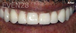 Scott-Niven-All-on-Four-Dental-Implants-after-1