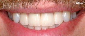 Scott-Niven-Dental-Crowns-after-3