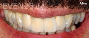 Scott-Niven-Dental-Crowns-after-9