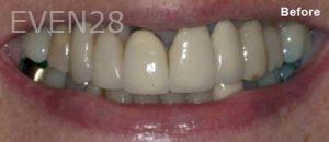 Scott-Niven-Dental-Crowns-before-1