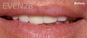 Scott-Niven-Dental-Crowns-before-10