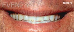 Scott-Niven-Dental-Crowns-before-2