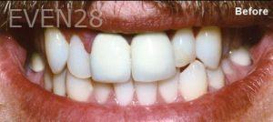 Scott-Niven-Dental-Crowns-before-3