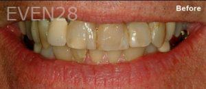 Scott-Niven-Dental-Crowns-before-7