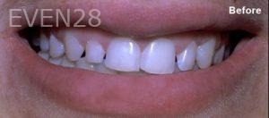 Scott-Niven-Dental-Crowns-before-8