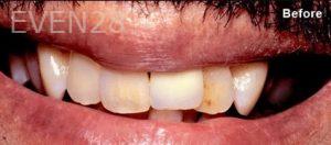 Scott-Niven-Dental-Crowns-before-9