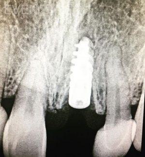 Sean-Pierce-Dental-Implant-After-1a