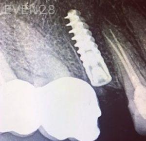 Sean-Pierce-Dental-Implant-After-3