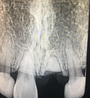 Sean-Pierce-Dental-Implant-Before-1a