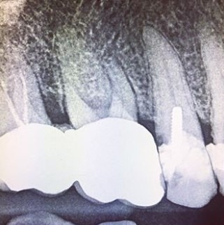 Sean-Pierce-Dental-Implant-Before-3