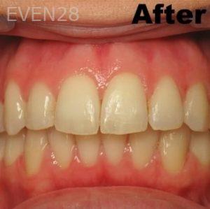 Soheir-Azer-Invisalign-clear-aligners-after-1b