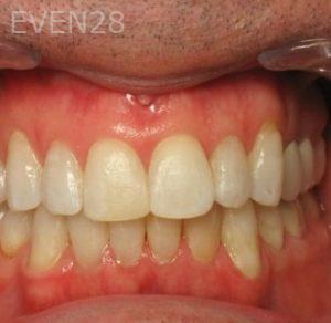 Soheir-Azer-Invisalign-clear-aligners-after-2b