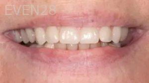 Taylor-Rice-All-on-four-Dental-Implants-after-1b