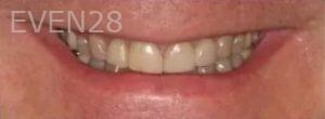 Taylor-Rice-Dental-Crown-before-3b