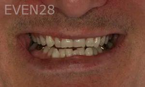 Taylor-Rice-Full-Mouth-Reconstruction-before-3b