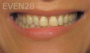 Ty-Caldwell-Dental-Crowns-before-1