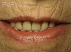 Ty-Caldwell-Dentures-before-1