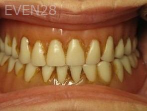 Ty-Caldwell-Dentures-before-1b