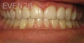 Ty-Caldwell-Invsialign-clear-aligners-after-1