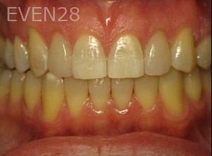Ty-Caldwell-Invsialign-clear-aligners-after-2