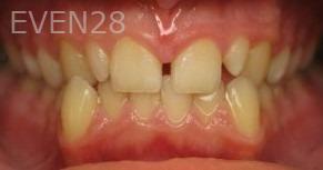 Ty-Caldwell-Invsialign-clear-aligners-before-1