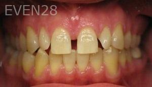 Ty-Caldwell-Invsialign-clear-aligners-before-2