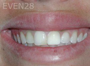 William-Dapper-Dental-Bonding-before-1