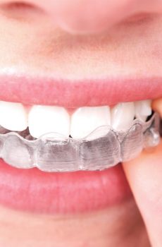 invisalign-clear-aligners