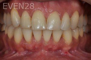 Aria-Irvani-Invisalign-Clear-Aligners-after-1