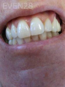Ali-John-Jazayeri-Teeth-Whitening-before-3