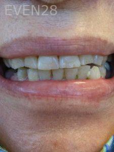 Ali-John-Jazayeri-Teeth-Whitening-before-2
