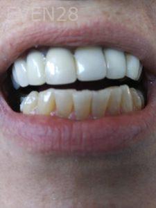 Ali-John-Jazayeri-Teeth-Whitening-before-6