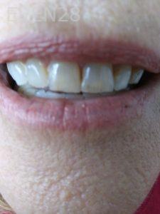 Ali-John-Jazayeri-Teeth-Whitening-before-5