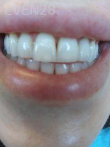 Ali-John-Jazayeri-Teeth-Whitening-before-4