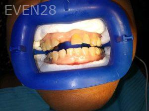 Ali-John-Jazayeri-Teeth-Whitening-before-1