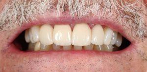 Ahmad-Aghakhan-Moheb-Dr-Sasha-Dental-Crowns-after-5