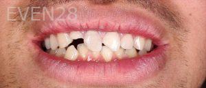 Ahmad-Aghakhan-Moheb-Dr-Sasha-Dental-Crowns-before-1
