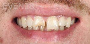 Ahmad-Aghakhan-Moheb-Dr-Sasha-Dental-Crowns-before-2